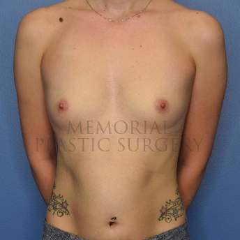 Breast Surgery Procedures Archives