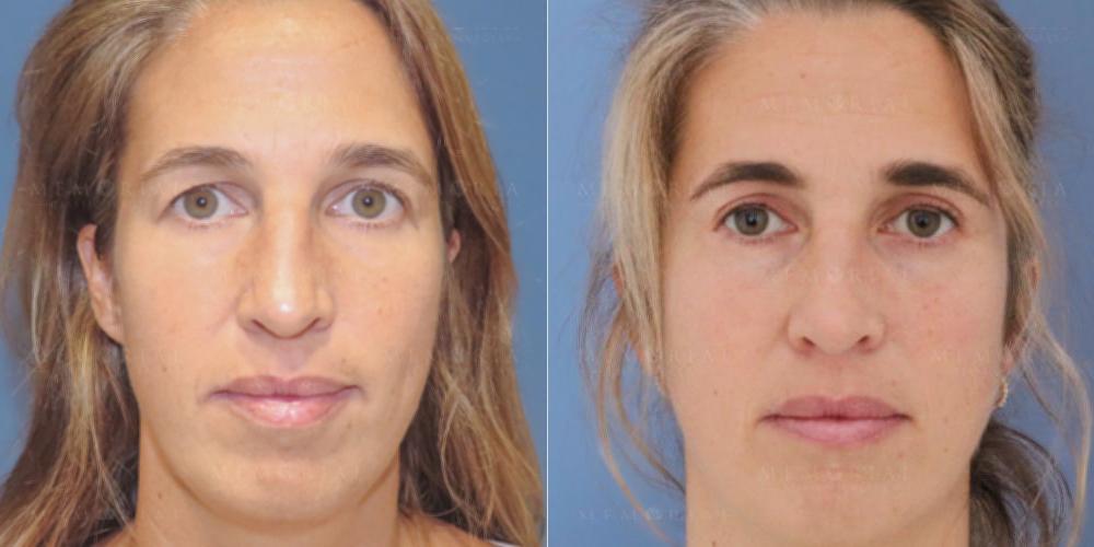 Before and After Photo