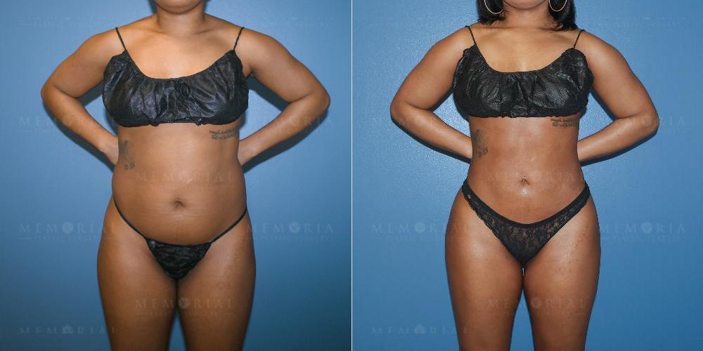 Before and After Photo