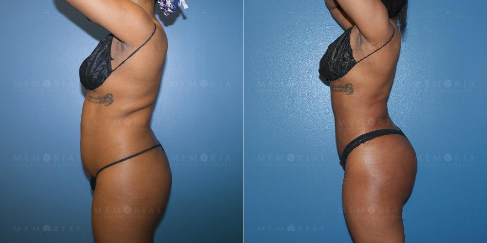 side View