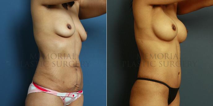 oblique View