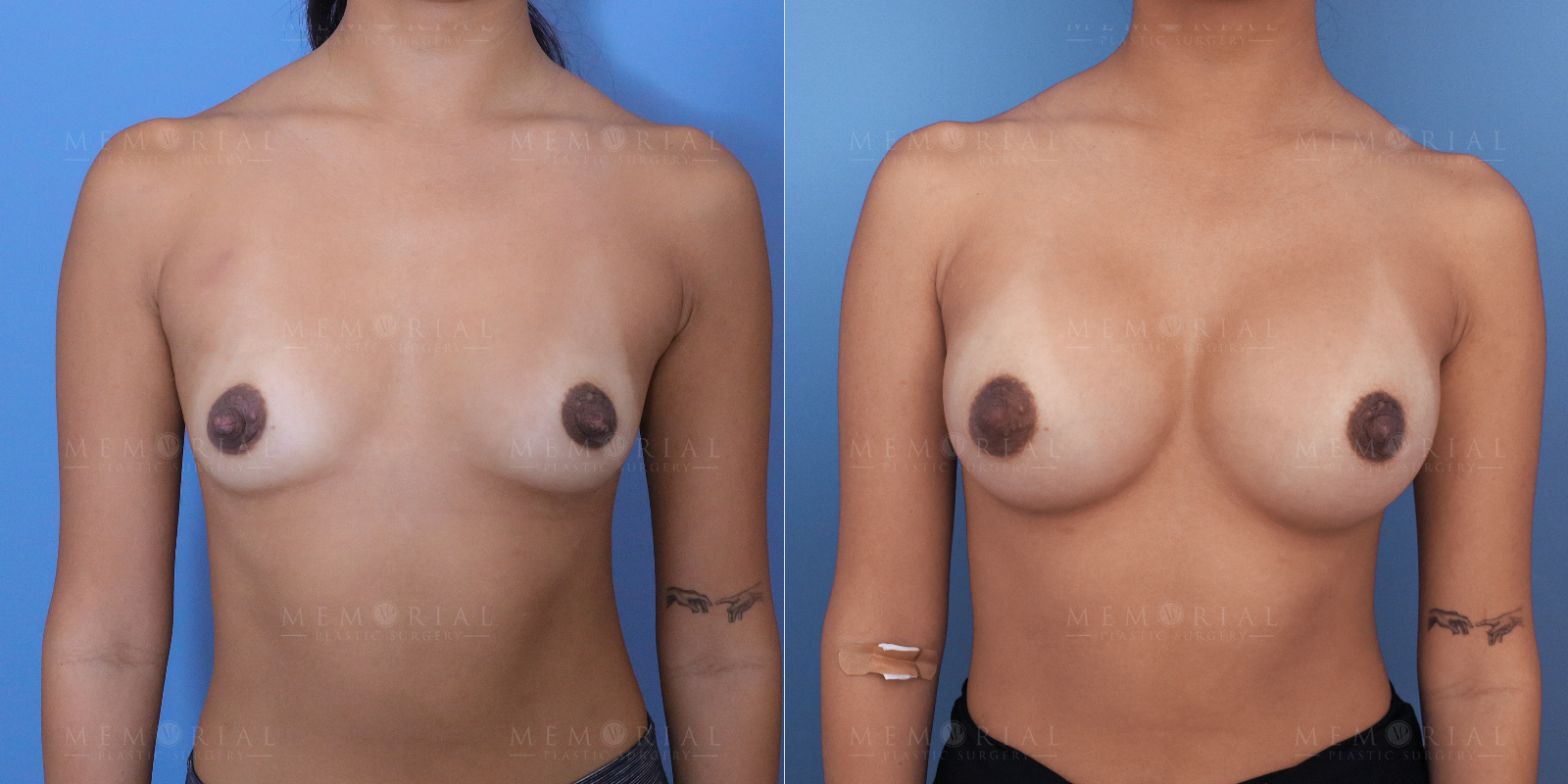 Before and After Photo