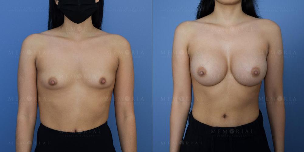 Before and After Photo
