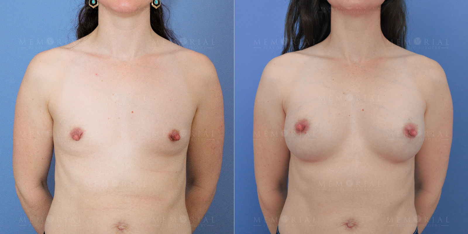 Before and After Photo