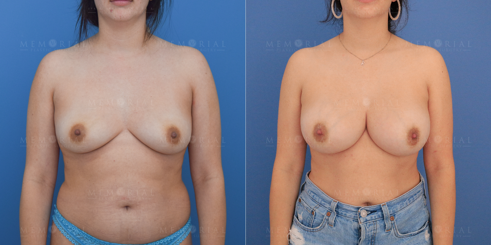 Before and After Photo