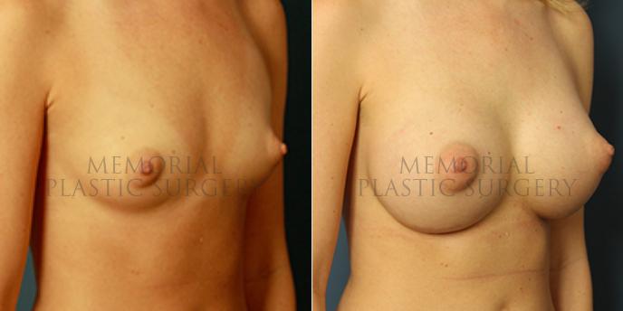 oblique View