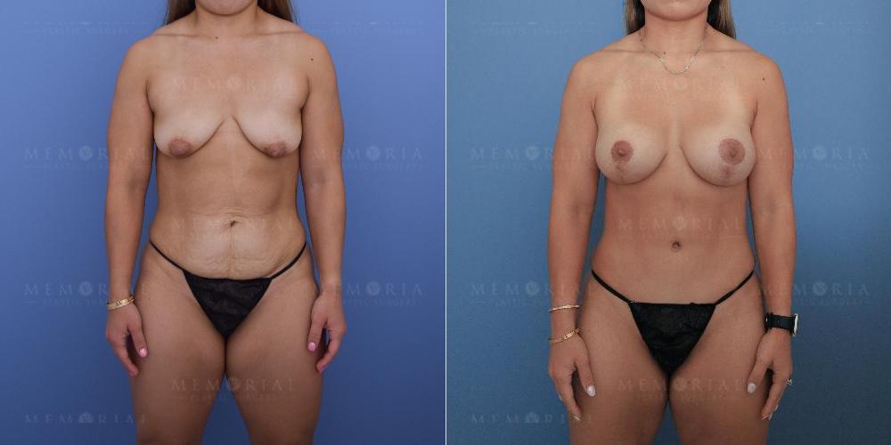 Before and After Photo
