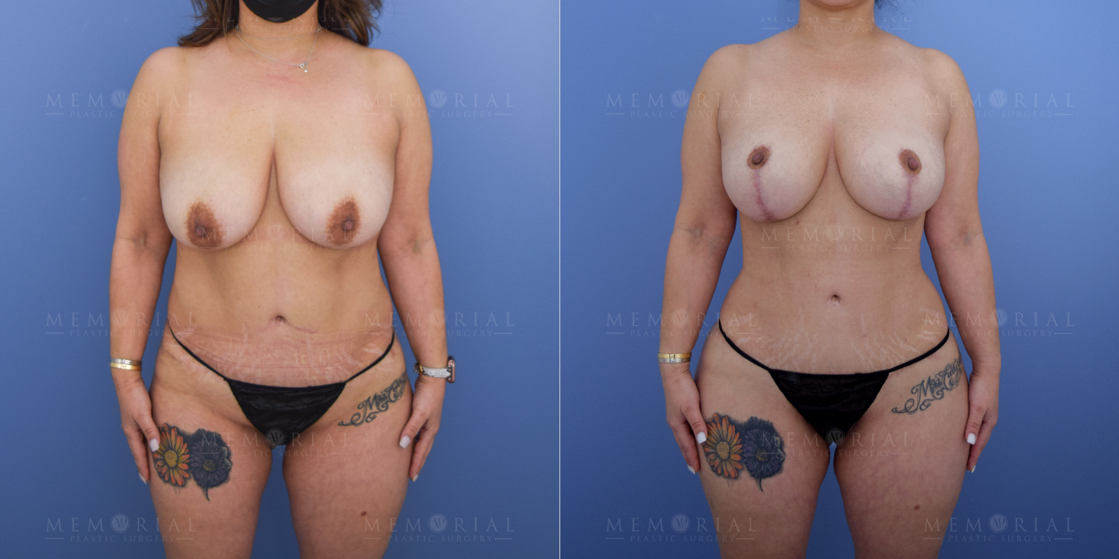 Before and After Photo