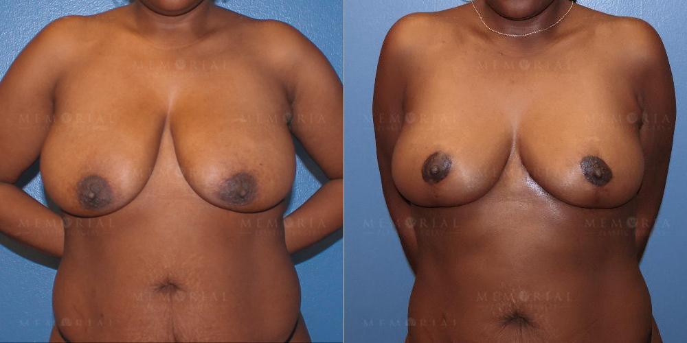 Before and After Photo