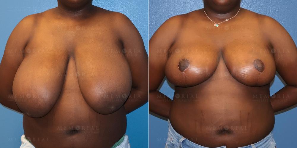 Before and After Photo