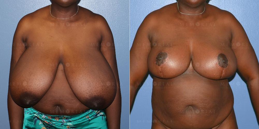 Before and After Photo