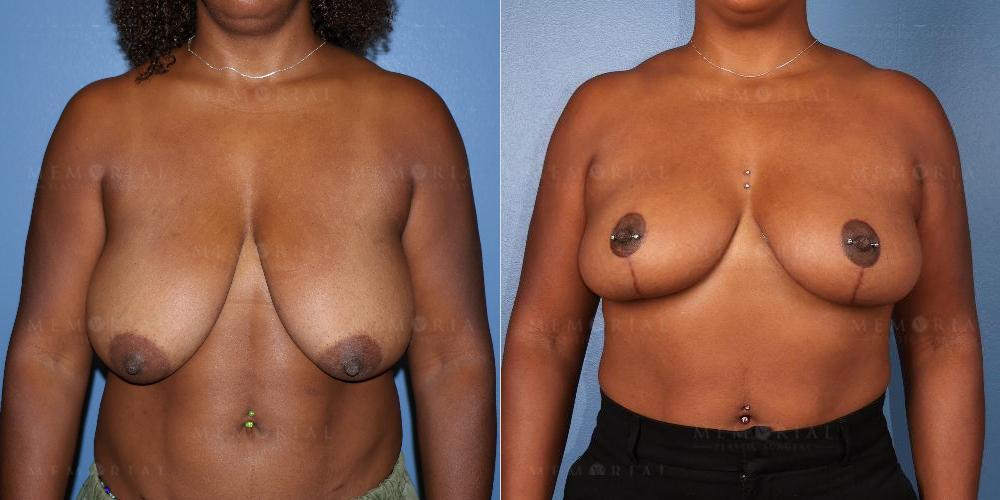 Before and After Photo