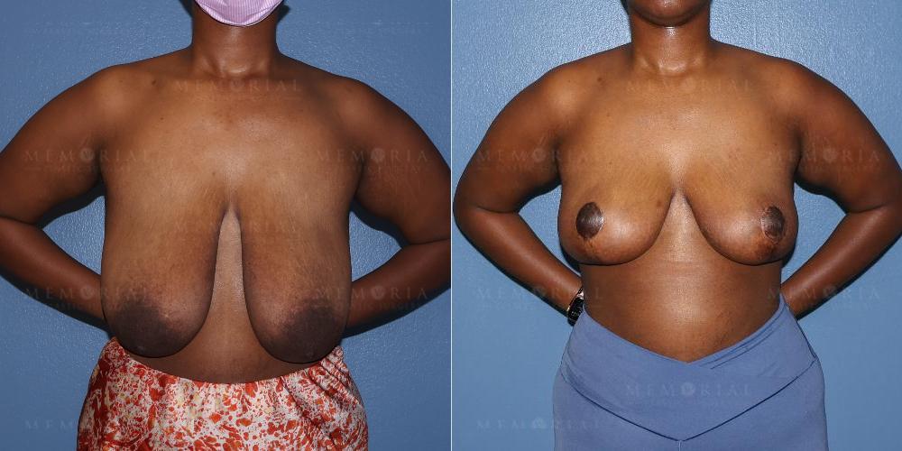 Before and After Photo