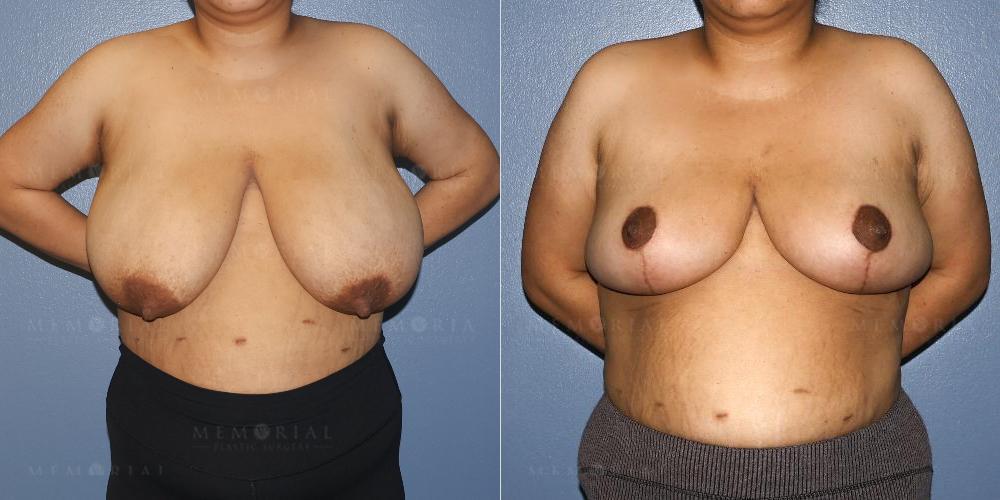 Before and After Photo