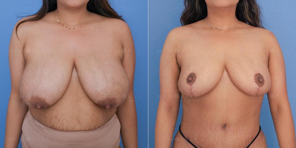 Before and After Photo
