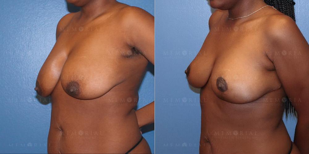 oblique View