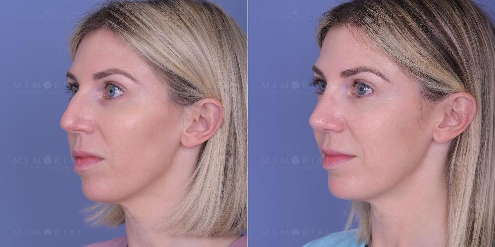 Before and After Photo