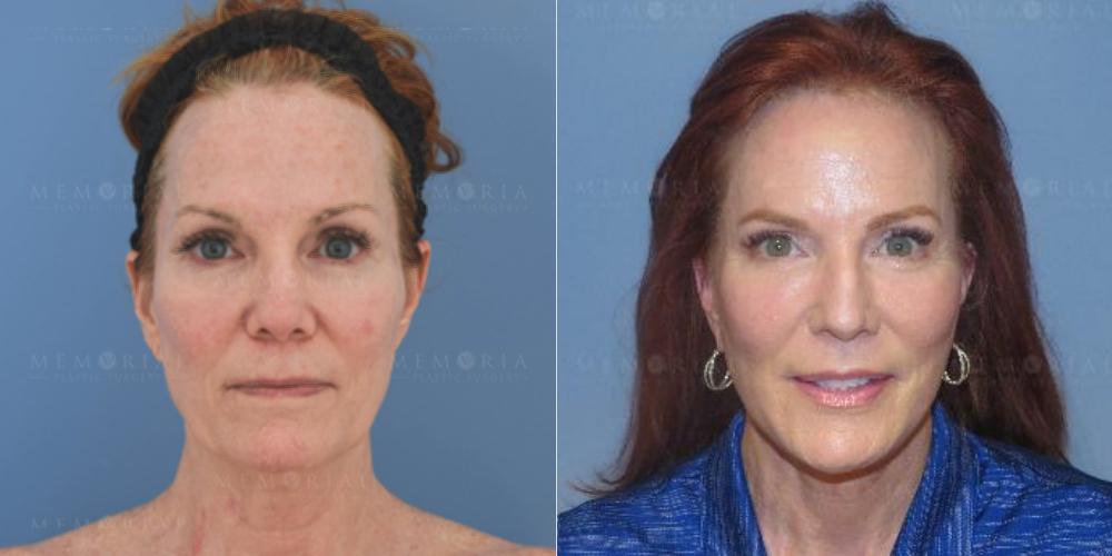 Before and After Photo