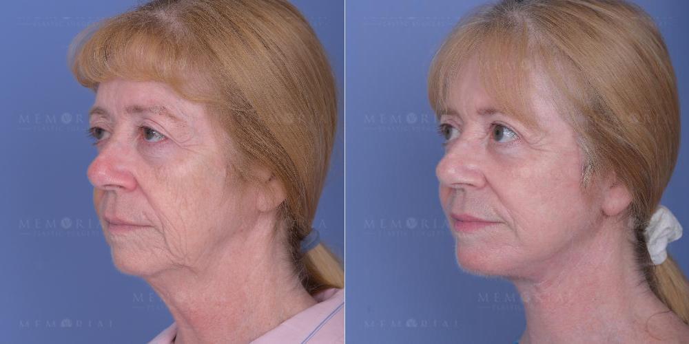 Before and After Photo