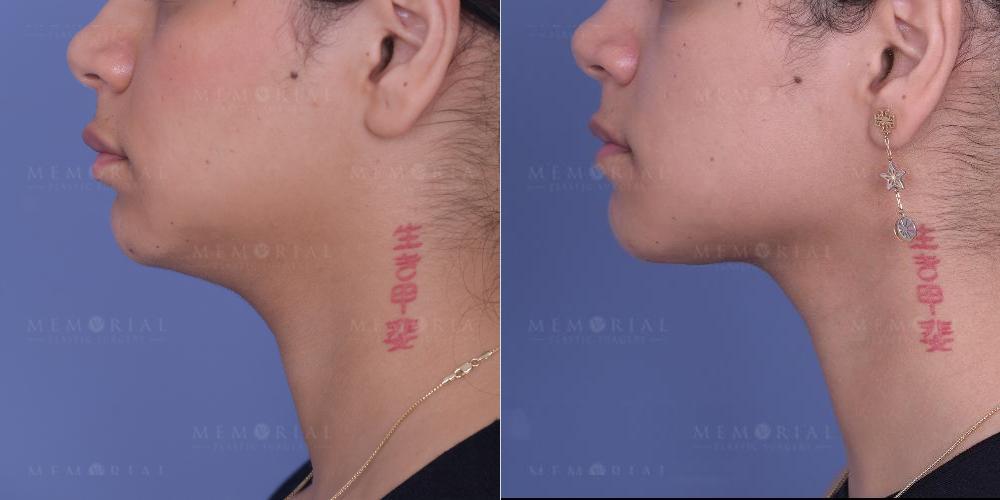 Before and After Photo