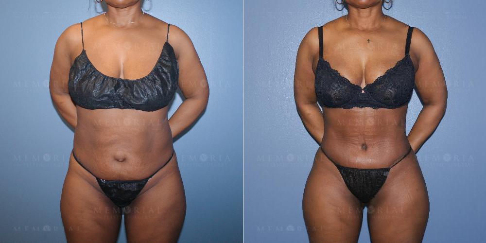 Before and After Photo
