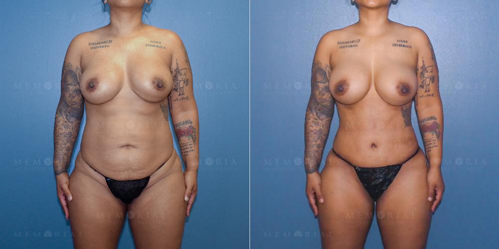 Before and After Photo
