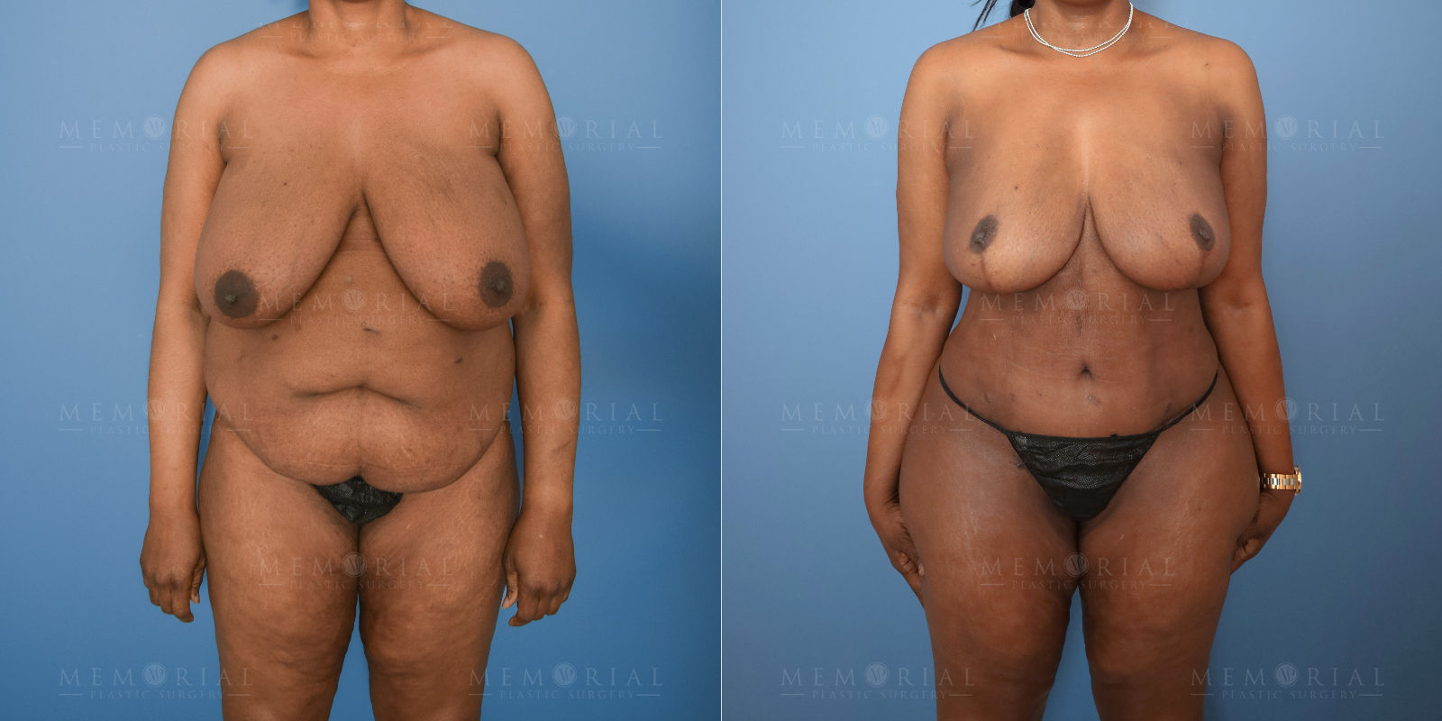 Before and After Photo