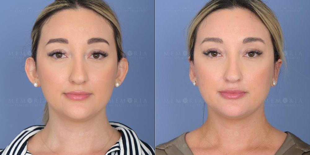 Before and After Photo