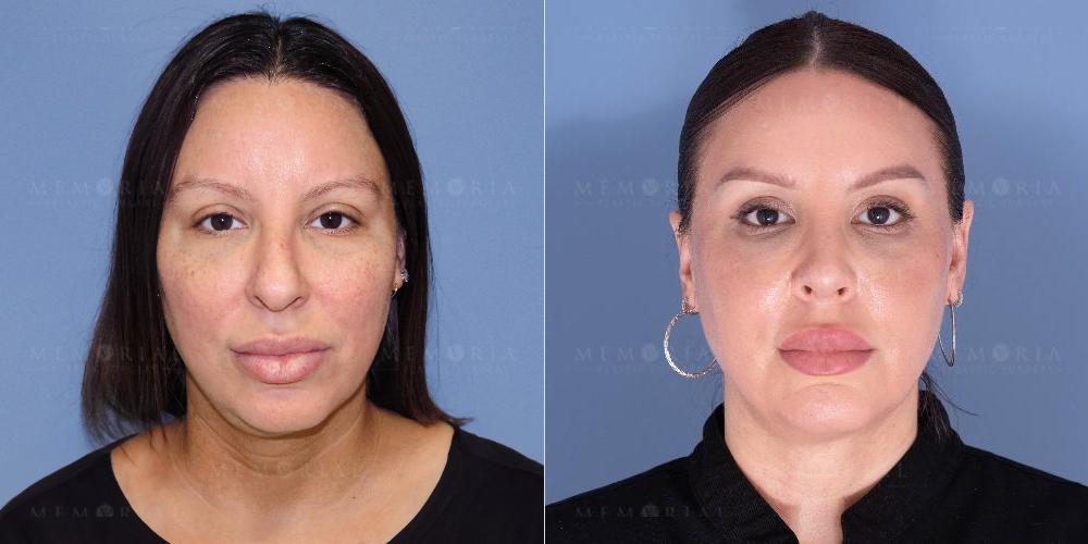 Before and After Photo
