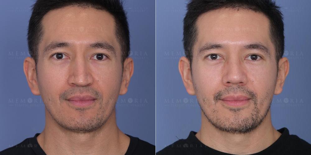 Before and After Photo
