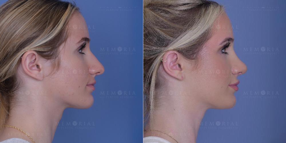 side View