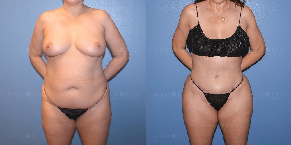 Before and After Photo