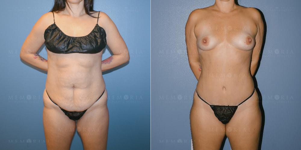 Before and After Photo