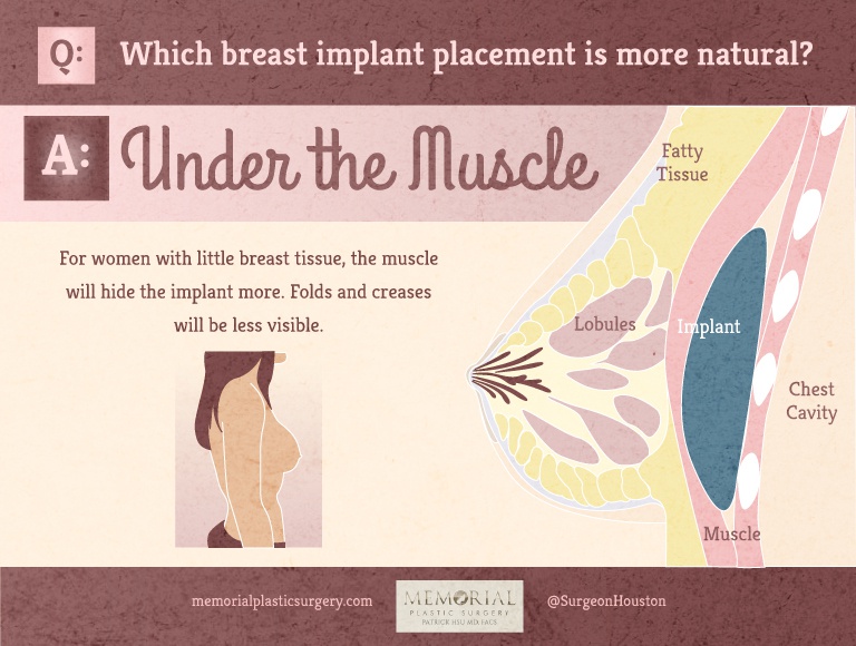 What is Breast Augmentation vs Implants in Detail?