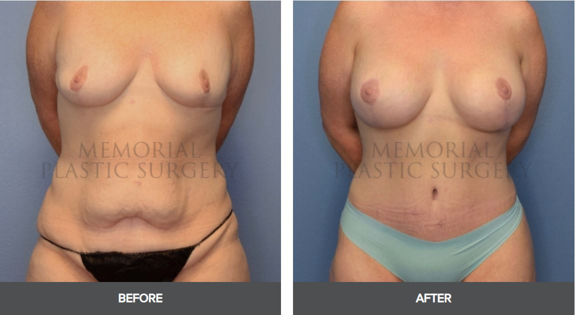 Do You Need a Breast Augmentation of Breast Lift?: Sam W