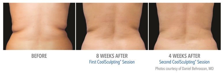 Treating the mons pubis with CoolSculpting