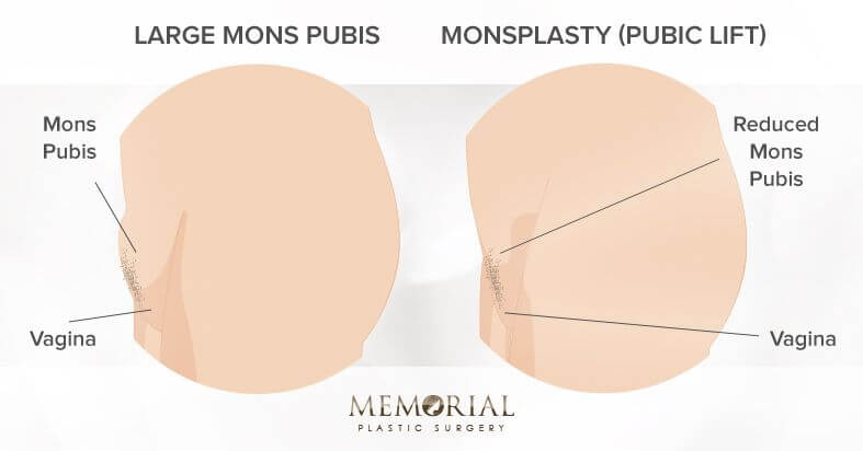 Tummy tuck with liposuction of the mons pubis, and a pubic lift 