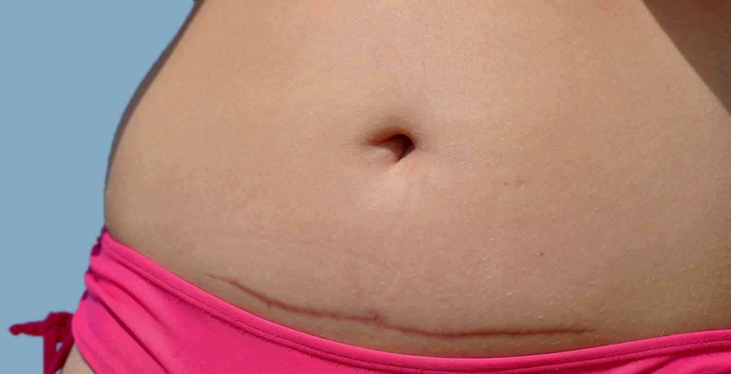 tummy tuck after c section