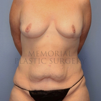 Breast Augmentation Before