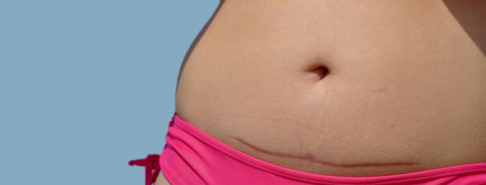 tummy tuck after c section