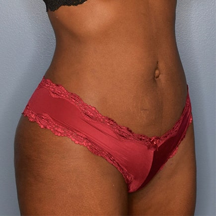 liposuction after