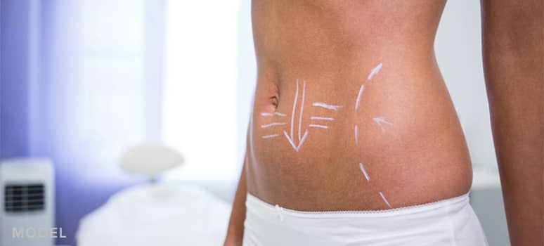 How to Prevent and Correct Uneven Areas in Your Belly After Liposuction