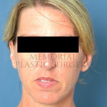 rhinoplasty before