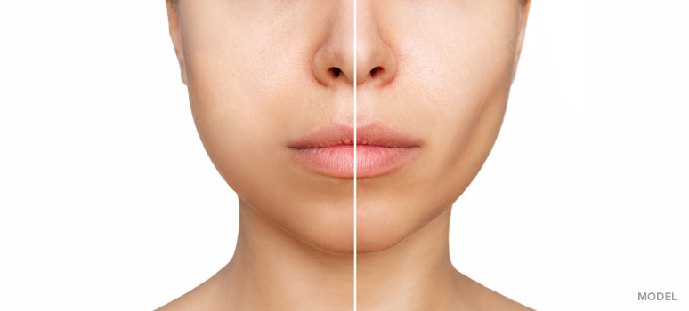 How You Can Get Contoured Cheeks With Buccal Fat Pad Removal - Dr. Vasilakis