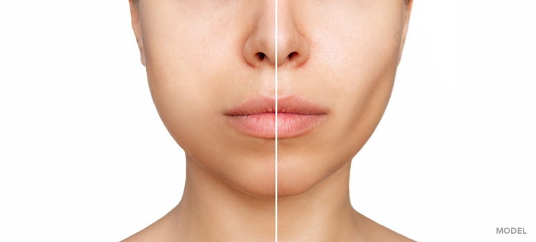 https://www.memorialplasticsurgery.com/wp-content/uploads/2022/09/get-contoured-cheeks-with-buccal-fat-pad-removal.jpg