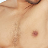 Is Gynecomastia Surgery Painful?