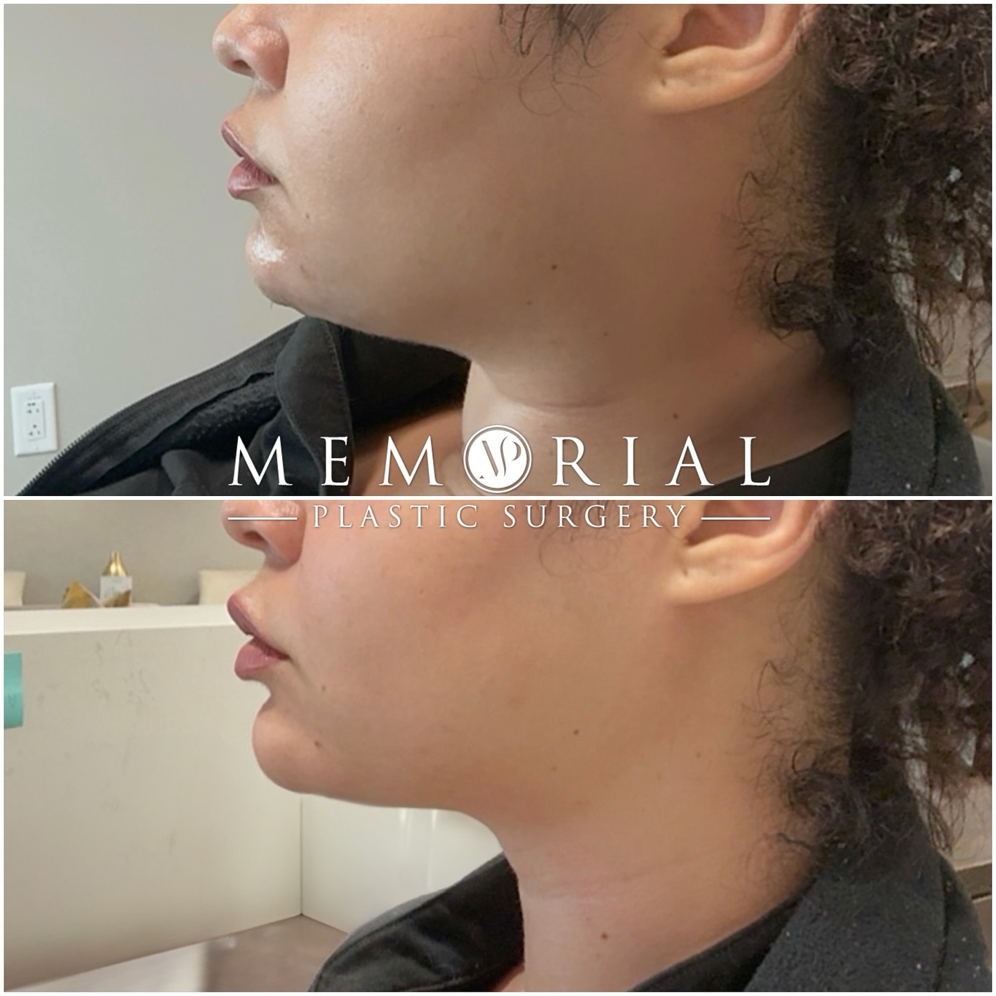 Non-Surgical Results 🔥🔥 

Great transformation after chin & jawline filler! 💉 These enhancements can make a huge difference in overall facial balance and definition 👌🏼 As you can see, it gave this patient a sharper, more contoured look without surgery! 🙌🏼

#jawlinefiller #chinfiller #filler #facialbalancing #beforeandafter #facialplasticsurgeon #MPSFace @memorialplasticsurgery