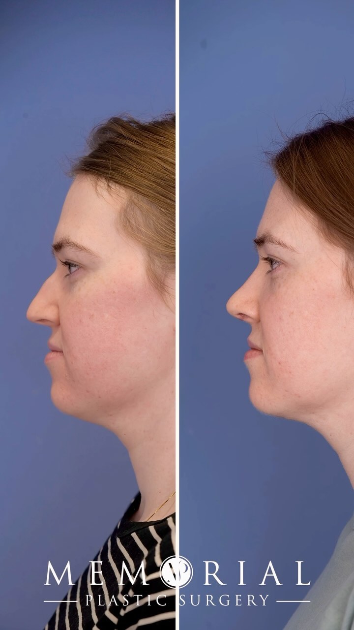 One month post-op and the results are already amazing! 👃🏼 This patient underwent a Rhinoplasty, Septoplasty, and Submental Lipo to enhance both function and appearance. The nose is now more balanced and breathing is improved! 👍🏼 It’s incredible what a combination of procedures can do to bring out your natural features. Excited to see the final results as healing continues! 

#Rhinoplasty #Septoplasty #SubmentalLipo #FacialSurgery #facialplasticsurgery #beforeandafter #Transformation #MPSFace @memorialplasticsurgery