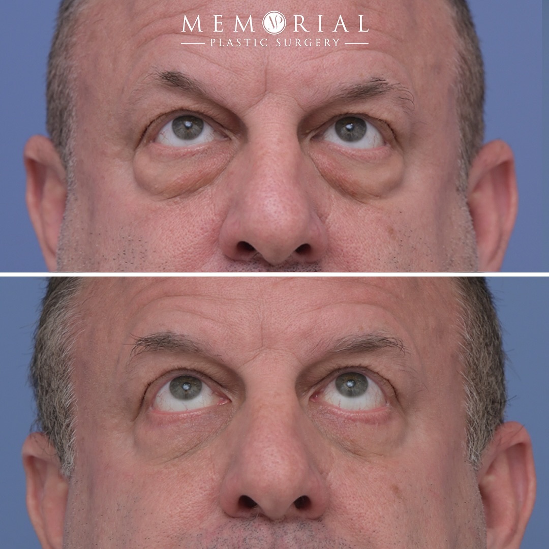 This patient’s 3-month post-op results after a Lower Lid Transconjunctival Blepharoplasty are looking fantastic! With no visible incisions, we’ve achieved a refreshed, natural look. This procedure is perfect for treating under-eye bags and restoring a more youthful appearance. 💪🏼

 #Blepharoplasty #UnderEyeRefresh #3MonthsPostOp #facialplasticsurgery #MPSFace @memorialplasticsurgery