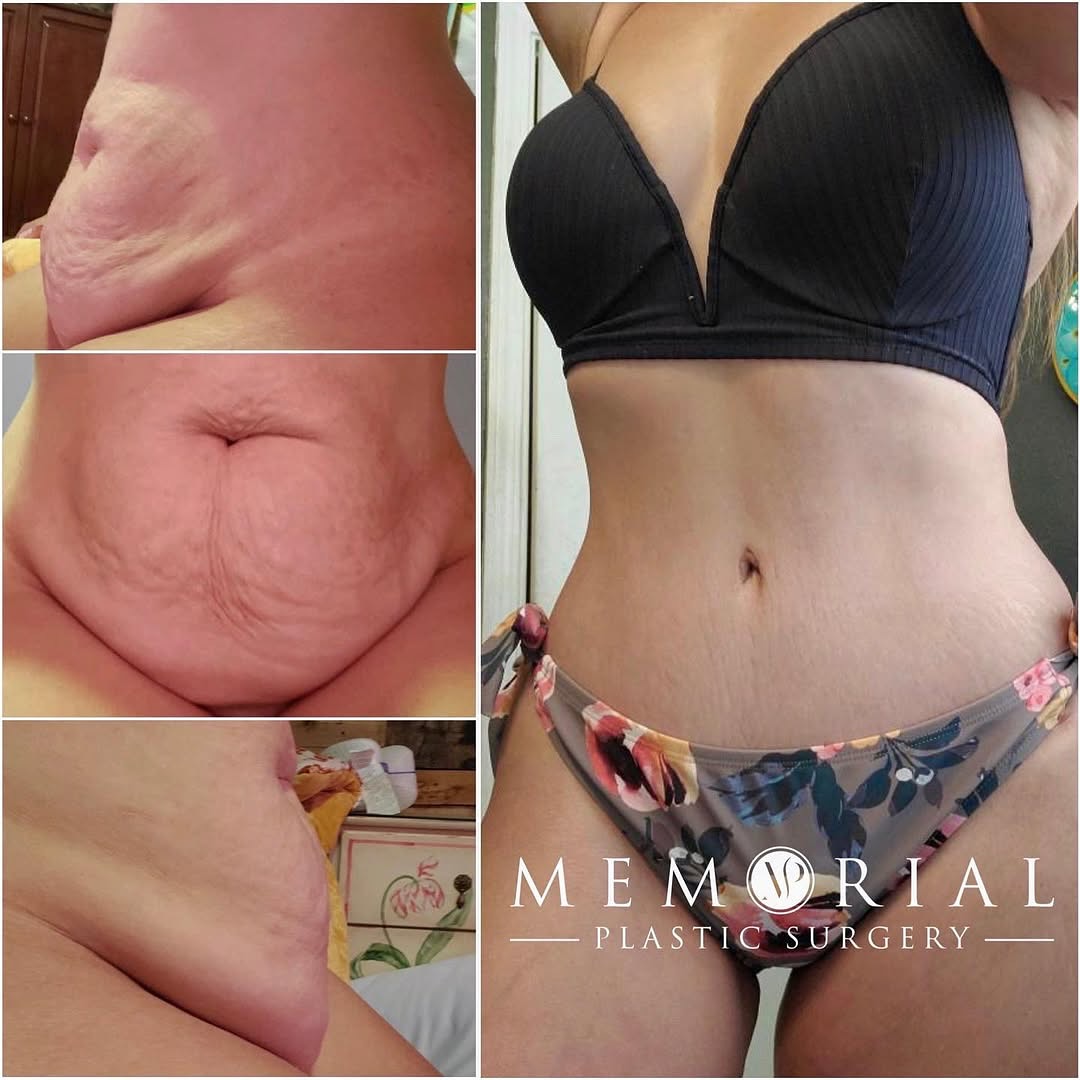 ❤️ This mommy looks amazing at almost 1 year post-op!! 😍
Procedure: #TummyTuck + #Liposuction of abdomen & flanks (Pre-Sx: Ht: 5’4 Wt: 130 lbs BMI: 22.3) #roehldoll
#beforeandafter #flatabs #transformation #mommymakeover #plasticsurgery #abdominoplasty #lipo #body #houston #austin #dallas #texas #houstonplasticsurgeon @memorialplasticsurgery